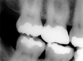  X-rays of teeth can reveal any damage or decay