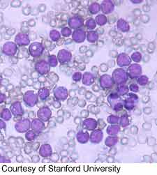 Leukemia effected blood cells can be viewed using a microscope.