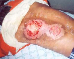 Severe radiation burns on the back of a man