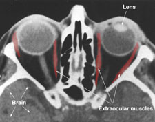 Ultrasonic scans of the human face show the proximity of the optic nerve, extraocular muscles, and brain.