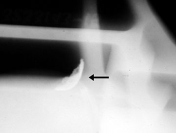 Radiograph of Inclusions.