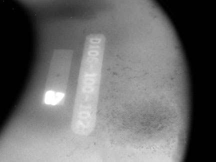 Radiograph of Sponge shrinkage.