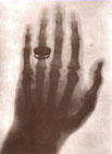 The x-ray image of a hand wearing a ring revealed a ring on a skeleton.