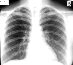  An X-ray image of a person's chest.