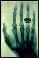 This is an X-ray image of a hand wearing a ring. This is one of the earliest X-ray images.