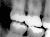  An X-ray image of teeth